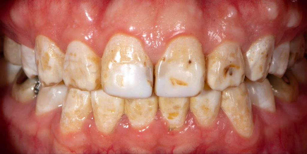 SB. Be careful!! This is what your teeth will become when you eat…